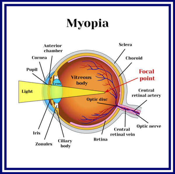 What is Myopia