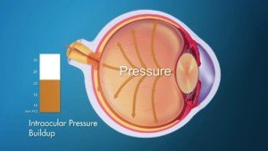 Development of Glaucoma