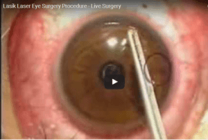 LASIK Laser Eye Surgery Procedure