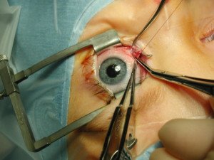 LASIK Laser Eye Surgery Procedure