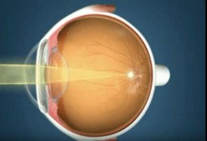 What is Astigmatism