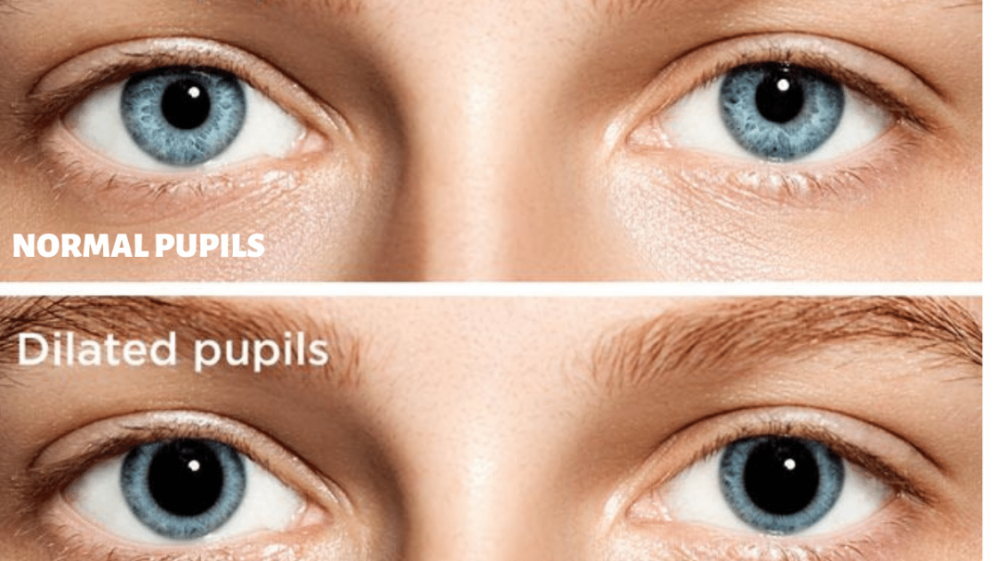 What Causes Dilated Pupils and How to Treat Them?