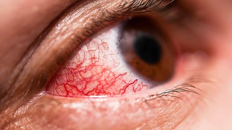 Conjunctivitis