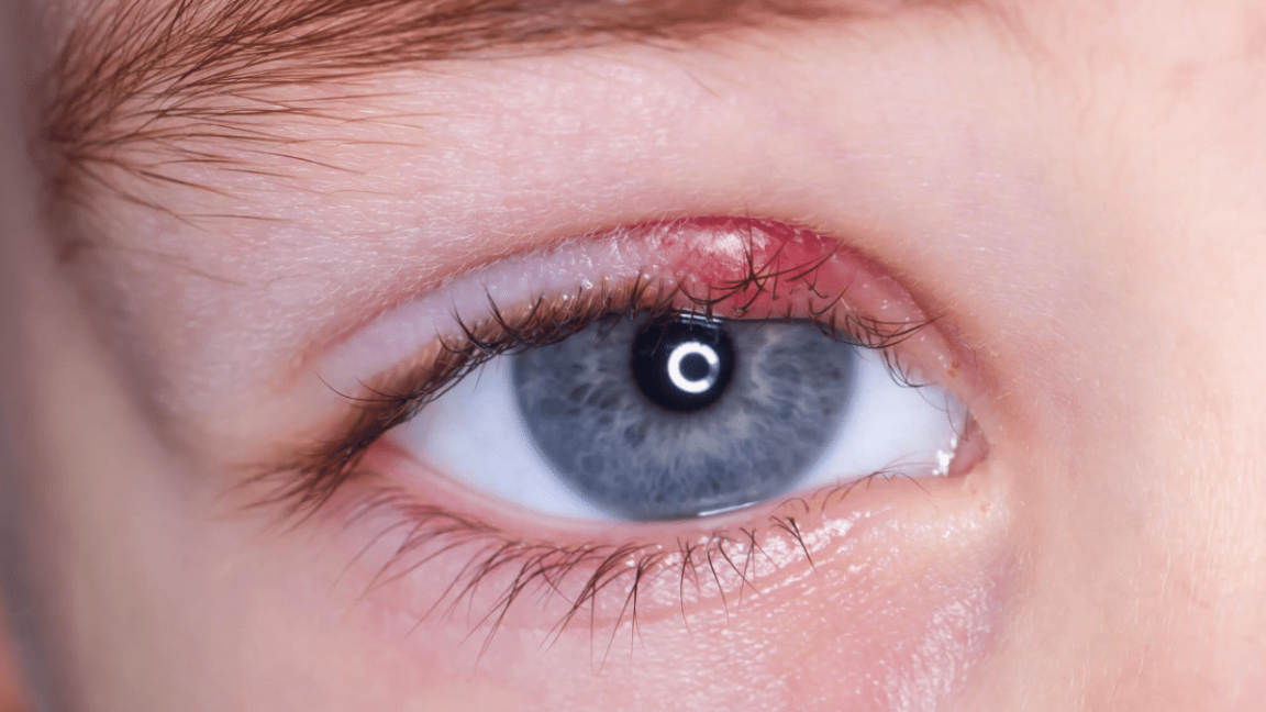 Cataracts - Causes, Symptoms, Diagnosis and Treatments