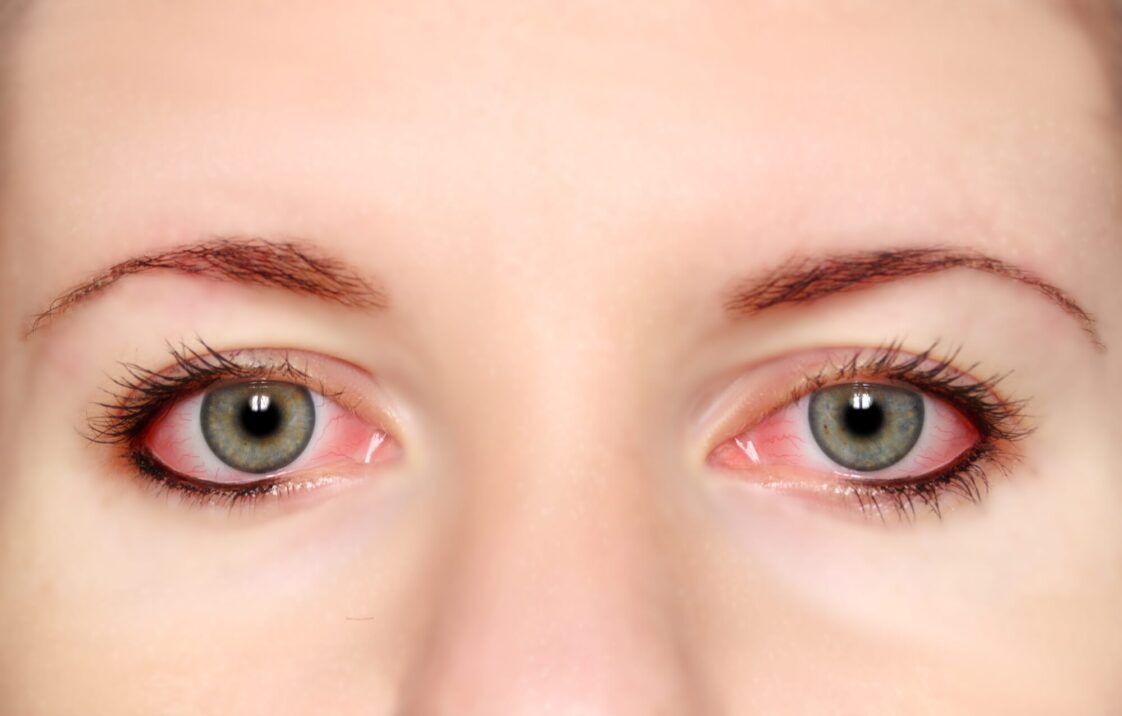 How Long is Pink Eye Contagious And What You Need To Know