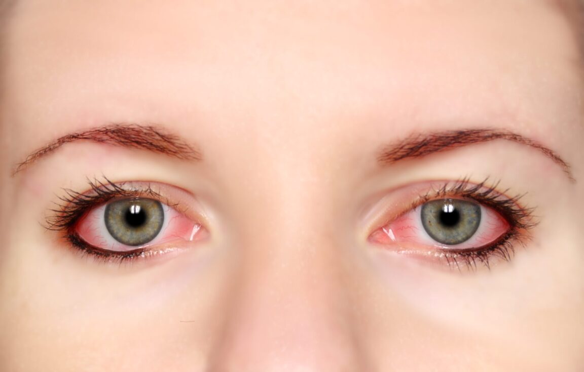  How Long Is Pink Eye Contagious And What You Need To Know