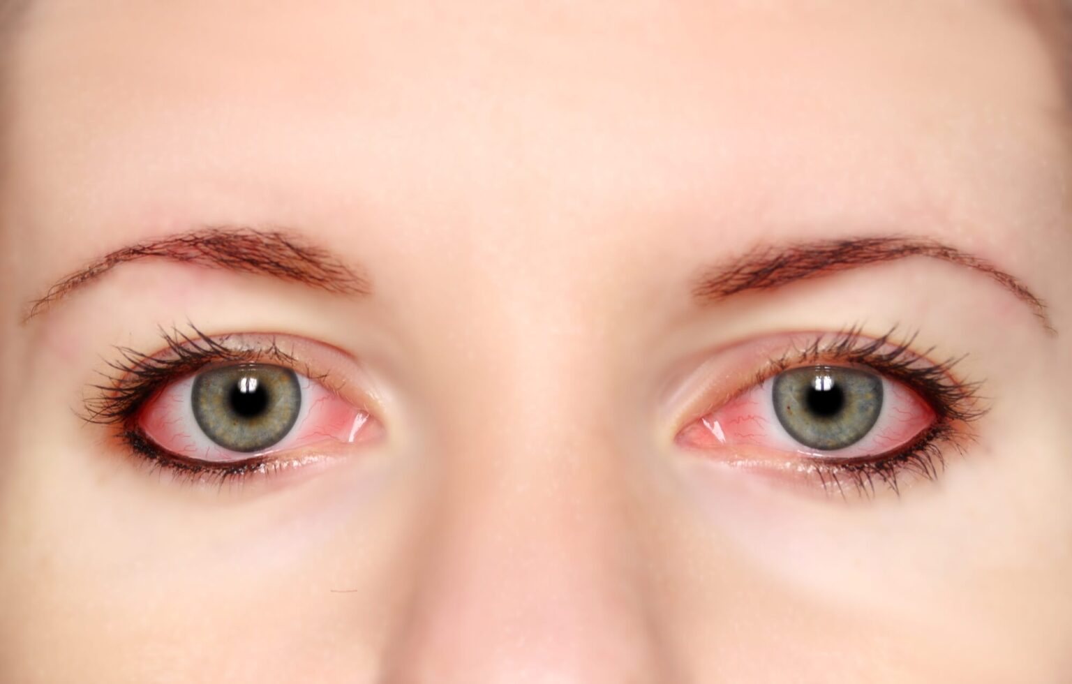 how-long-is-pink-eye-contagious-and-what-you-need-to-know