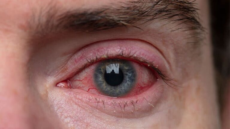 Blepharitis: Causes, Diagnosis, Treatment & Prevention