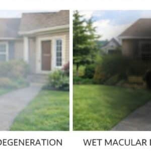 wet vs dry macular degeneration