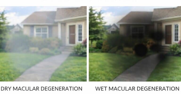 wet vs dry macular degeneration