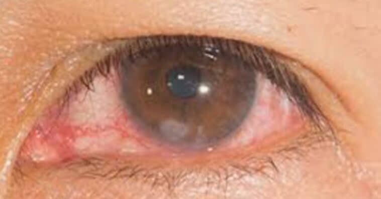 Corneal Abrasion
