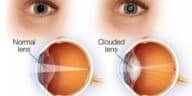 Early Cataract Symptoms