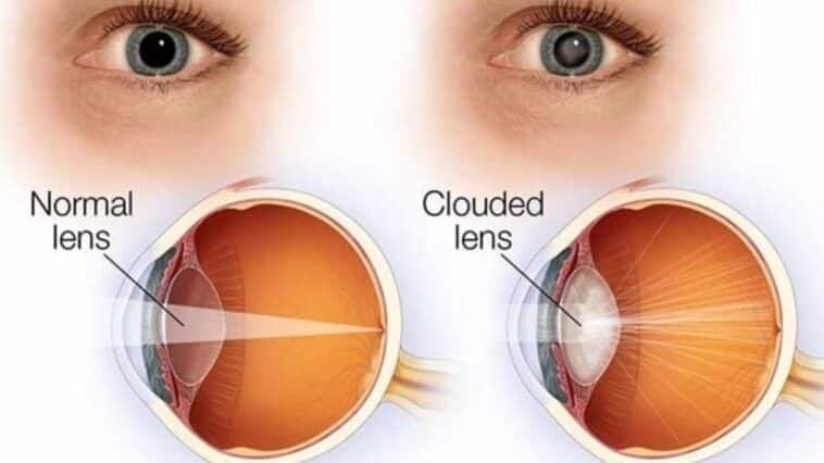 Early Cataract Symptoms